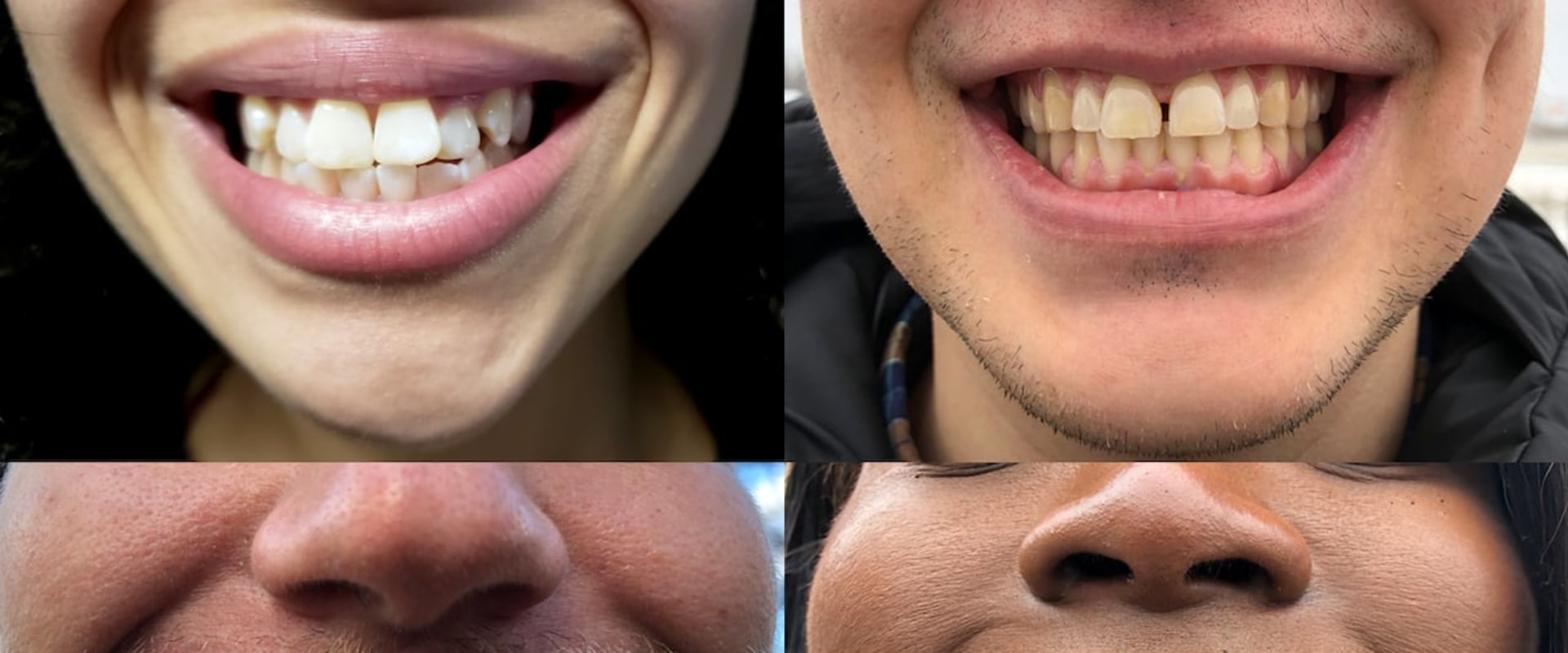 Can Smile Direct Really Fix Crooked Teeth? - An Expert's Perspective