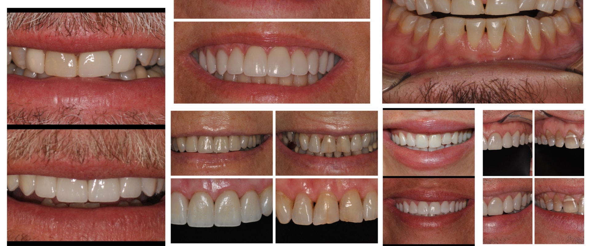 Achieve a Radiant Smile with a Smile Makeover