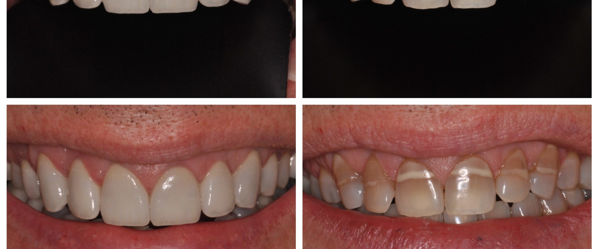 Smile Makeover: Get Rid of Stained Teeth and Enjoy a Beautiful New Smile