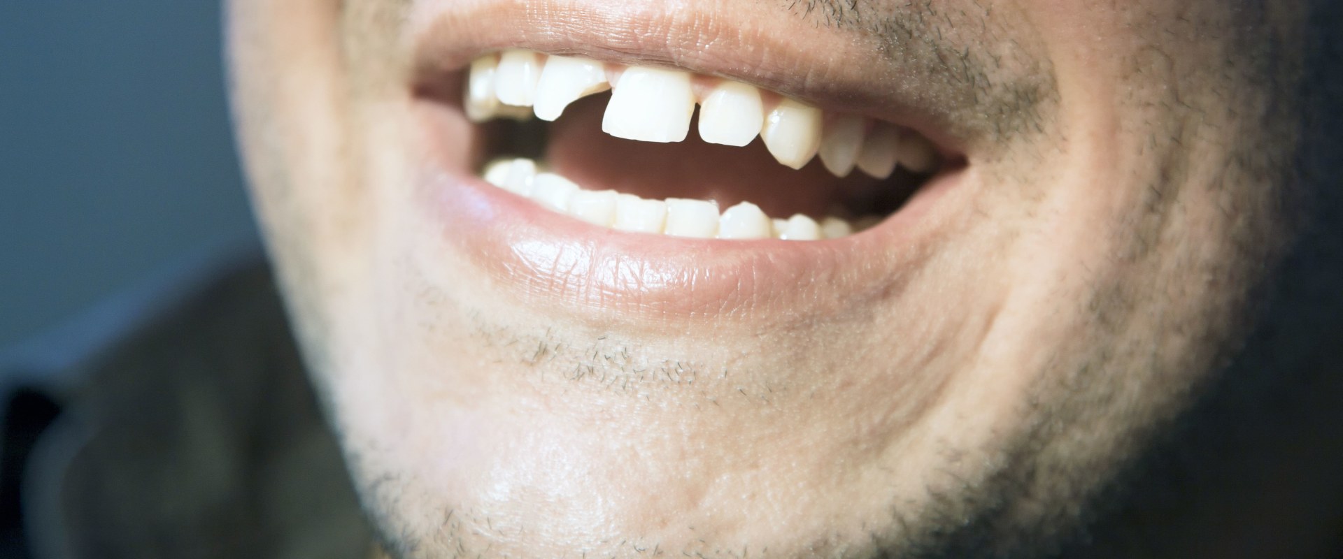 Smile Makeover: A Perfect Solution for Chipped Teeth