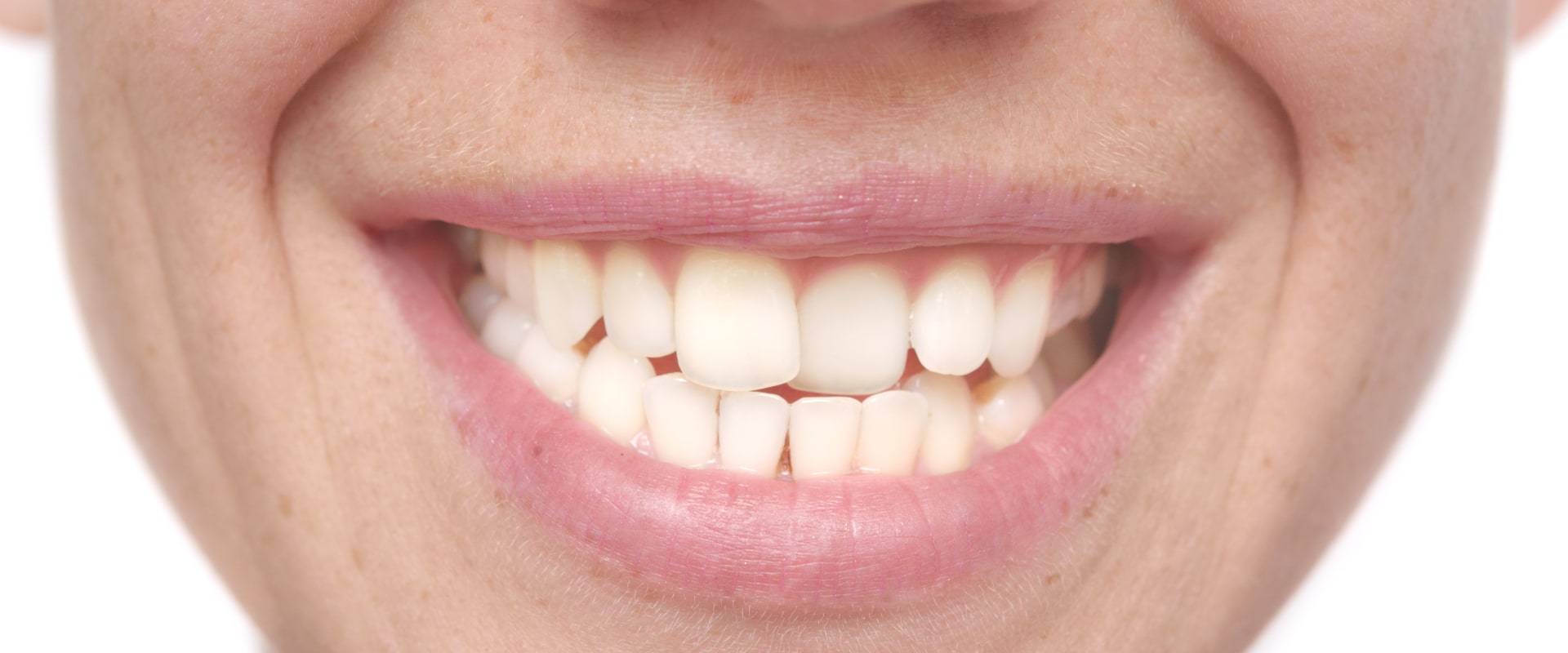 Smile Makeover for Crooked Teeth: Types of Treatments Explained