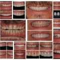Smile Makeover: Transform Your Smile with a Comprehensive Guide