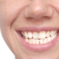 Smile Makeover for Crooked Teeth: Types of Treatments Explained