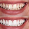 Smile Correction: A Comprehensive Guide to Achieving a Perfect Smile