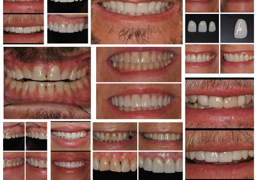 Achieve a Stunning Smile with a Smile Makeover