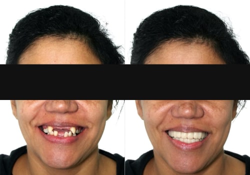 Does Snap-On Smile Work with Missing Teeth?