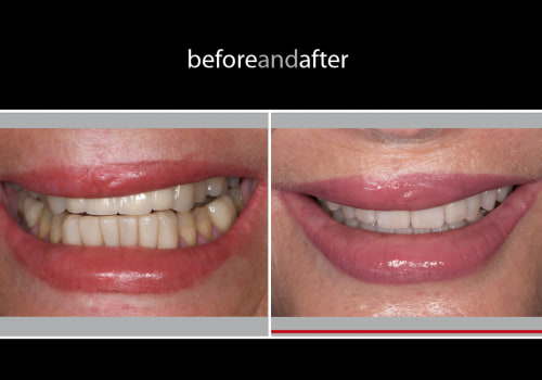 Smile Makeover vs Full Mouth Reconstruction: What's the Difference?