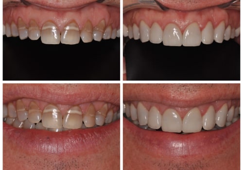 Smile Makeover: Get Rid of Stained Teeth and Enjoy a Beautiful New Smile