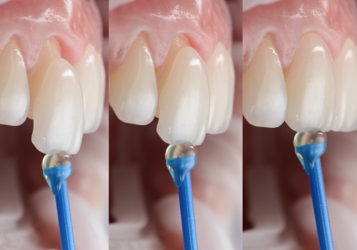 How Many Veneers Do You Need for a Perfect Smile Makeover?