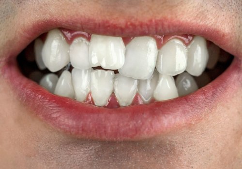 Smile Makeover: Get a Perfect Smile with Misaligned Teeth